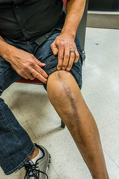 Roger Thompson reveals an impressive scar on his leg from a life-altering, dirt bike accident. Photo by Mason Callejas