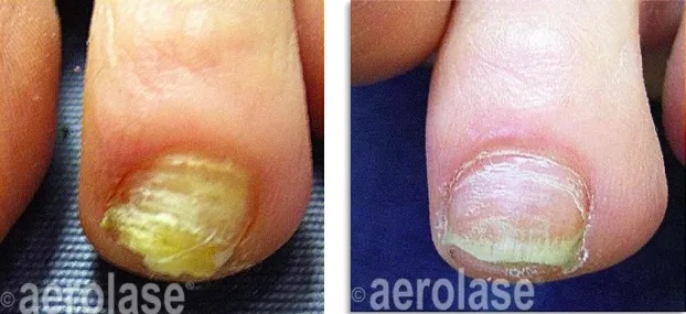 Lines on Nails: Here is What They Indicate - HealthKart